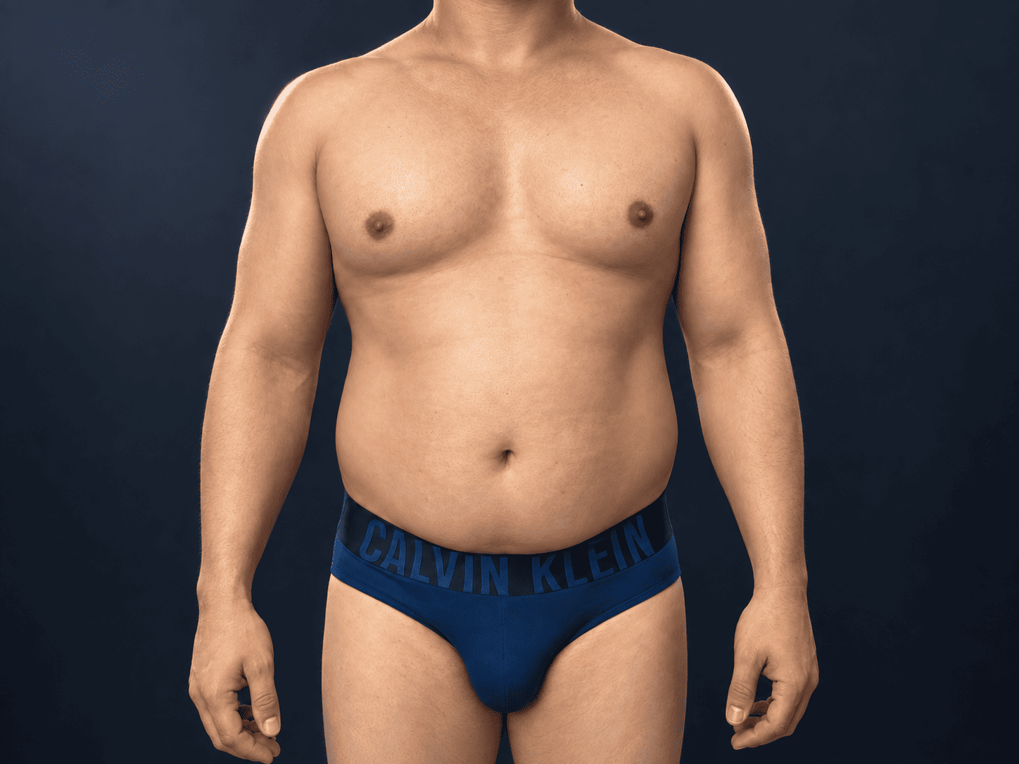 Antes de una lipoescultura realizada por el Dr. Carlos Betancur