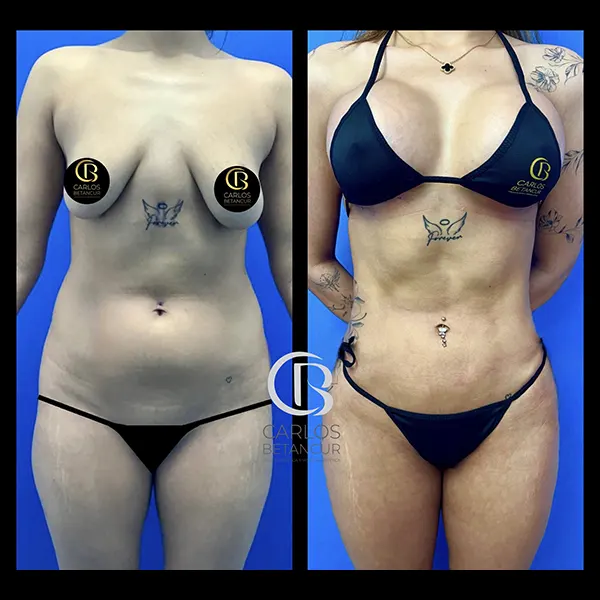 Resultado de lipoescultura para mujer